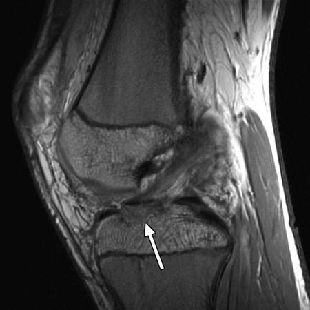 Tibial Eminence Anatomy