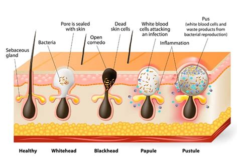 acne vulgaris: Origins, symptoms and current treatments