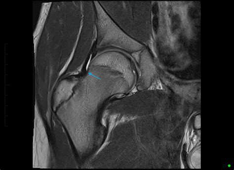 Normal Hip Mri