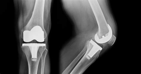 Total Knee Replacement Revision Surgery - New Iberia, LA - Orthopedic ...