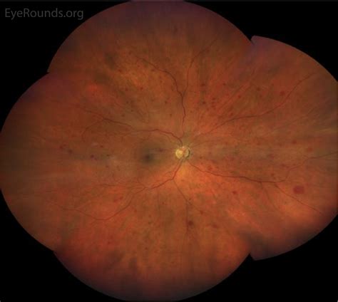 EyeRounds.org: Ocular Ischemic Syndrome