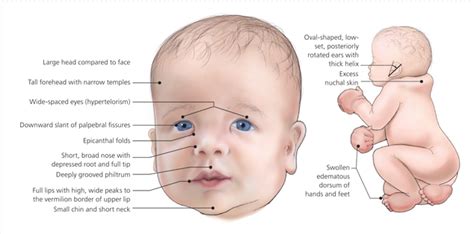 Down Syndrome (Trisomy 21) - Stepwards