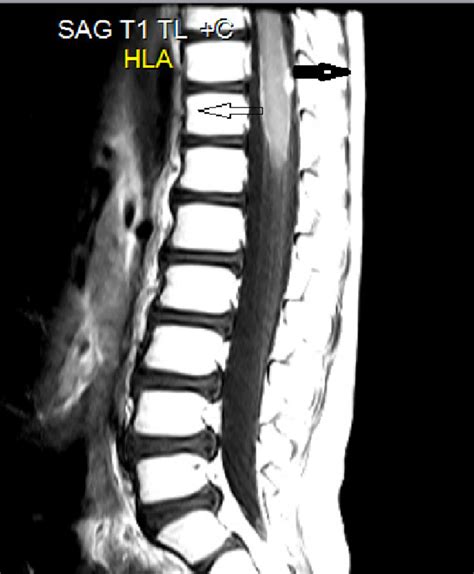 Sagittal T1-weighted post-contrast MRI of the thoracic spine ...