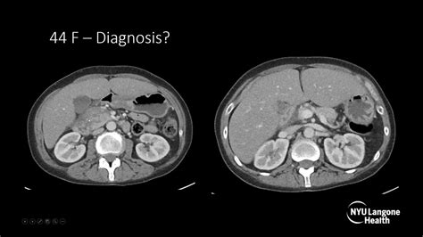 Normal Pancreas Cat Scan