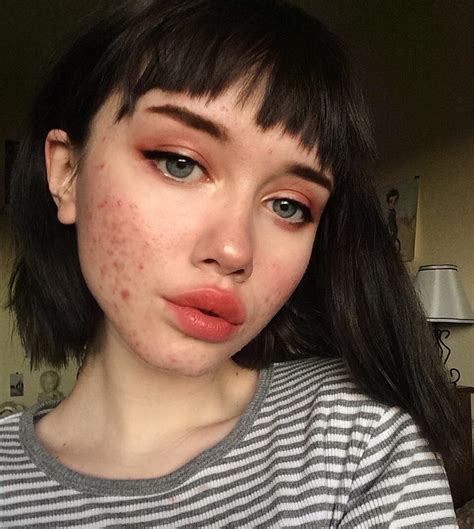 Teen Shares Viral Acne Message on Instagram | Teen Vogue