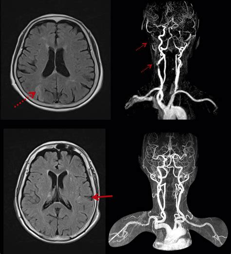 Magnetic resonance (MR) imaging of patients with ischemic stroke and ...