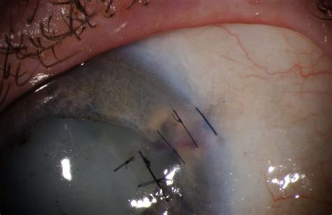 Moran CORE | Removal of Superficial Corneal Foreign Bodies