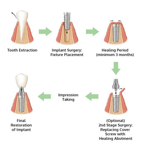 What Are Dental Implants and Am I Suitable for Them? - Medisave ...