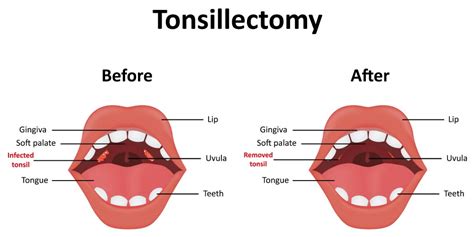 A Complete Guide to Tonsillectomy - Pristyn Care