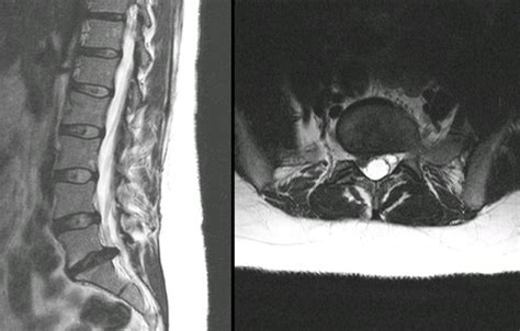 Lumbar Spine Mri Bulging Disc