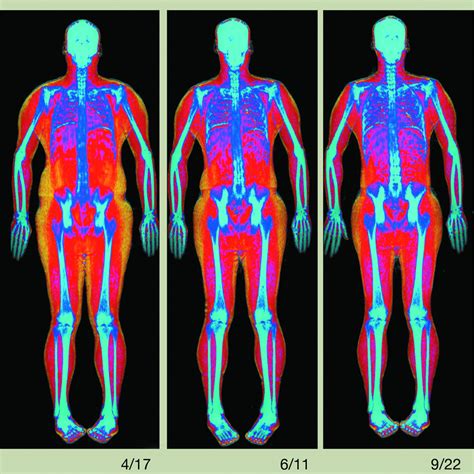 Too Much Fat? Try a Whole-Body Scan - WSJ