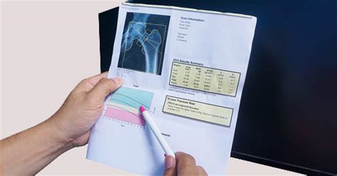 DEXA Scan / Bone Density Test: A Patient's Guide | HSS