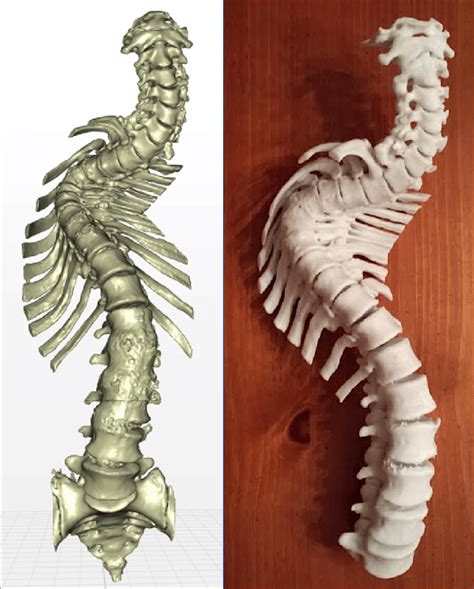 3D reconstruction of severely deformed spine, printed for surgical ...