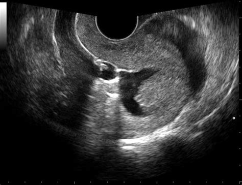 What Is a Sonohysterogram?