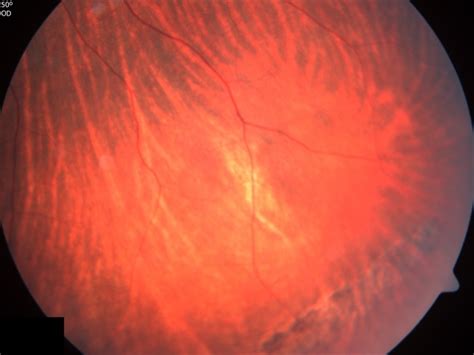 Peripheral Lattice Degeneration - Retina Image Bank