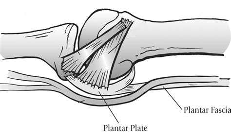 Plantar Plate Tear - Ankle, Foot and Orthotic Centre