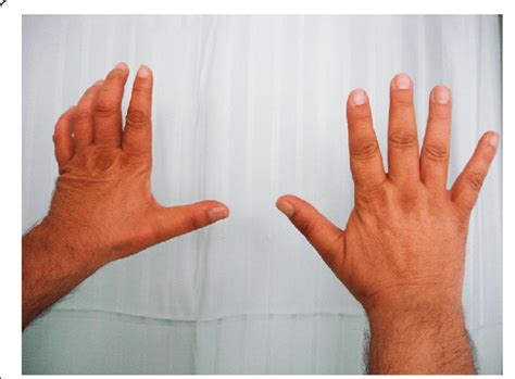 Photograph of the dorsum of the hands one year after surgery, showing ...