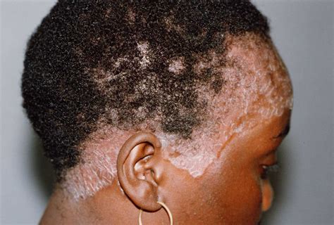 Pictures of scalp psoriasis | Symptoms and pictures