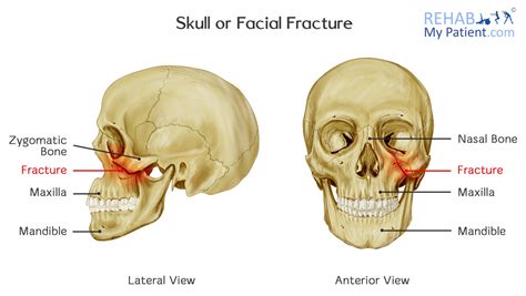 Maxilla Fracture