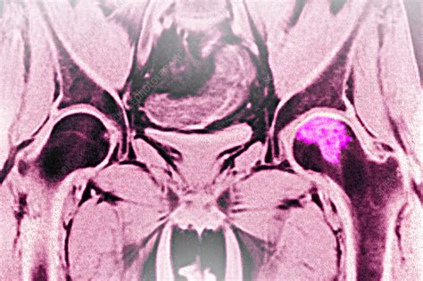 Hip osteoarthritis, MRI - Stock Image - C033/2975 - Science Photo Library