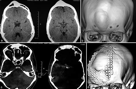 Surgical Neurology International