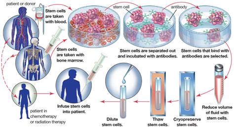 Bone Marrow Transplant - Donor, Procedure, Risks