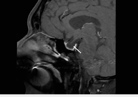 Sagittal T1-weighted MRI of the brain showing enlarged empty sella ...