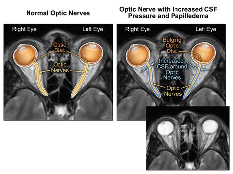 Normal Optic Nerve Mri