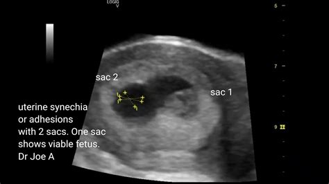 Uterine synechia or adhesions in early 7 weeks pregnancy: two gestation ...