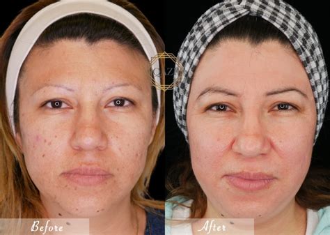 Understanding and Treating Acne Hyperpigmentation