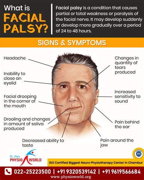 Facial Nerve Palsy Symptoms – NBKomputer