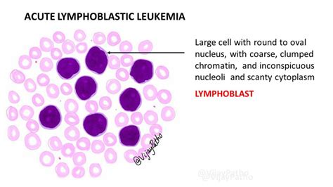 Peripheral smear findings in Leukemia - Illustrated - Pathology Made Simple