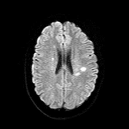 Dawson fingers | Radiology Reference Article | Radiopaedia.org