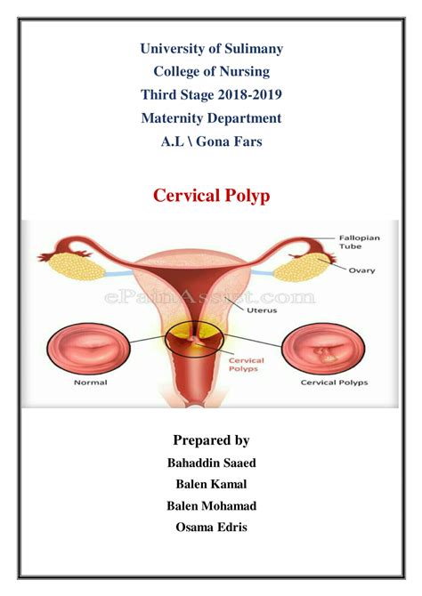 (PDF) Cervical polyp