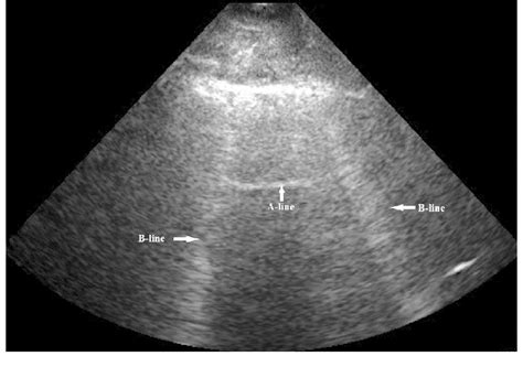 Kerley B Lines Pulmonary Edema