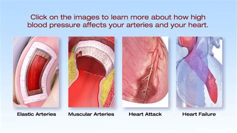 Hypertension Causes And Effects