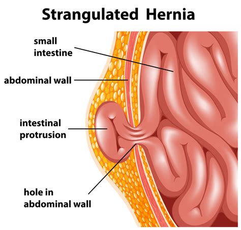 Abdominal Wall Hernia Repair | GlobeHealer