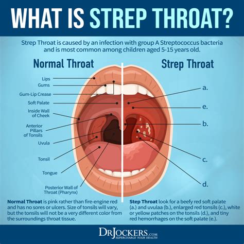 Strep Throat: Symptoms and 15 Natural Support Strategies