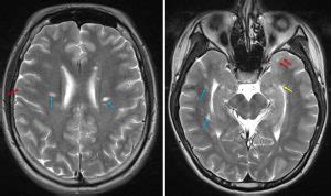 Dawson fingers (multiple sclerosis) – Radiology Cases