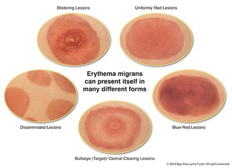 Does Everyone Get the Telltale Bullseye Rash? | Bay Area Lyme Foundation