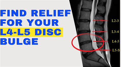 10 Things L4-L5 Disc Bulge Patients Need to Know for a Speedy Recovery ...