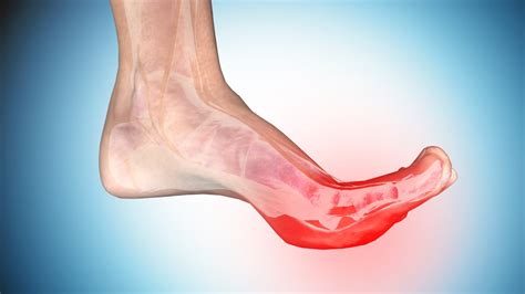 Foot Cramps: Causes and Ways to Get Rid of Cramps in Foot and Toe - YouTube