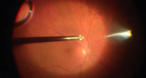 Pars Plana Vitrectomy - Wills Eye Library