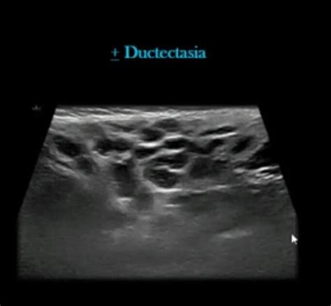 Neck ultrasound Dilated tortious parotid ducts with small sized gland ...