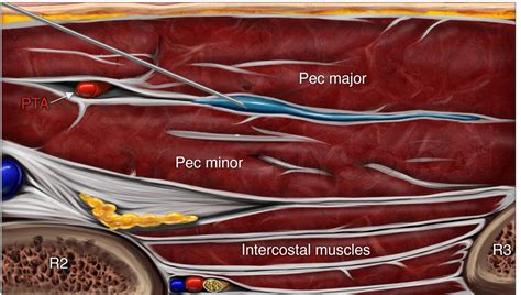 Húmedo Puede soportar Culpa serratus anterior nerve block absorción ...