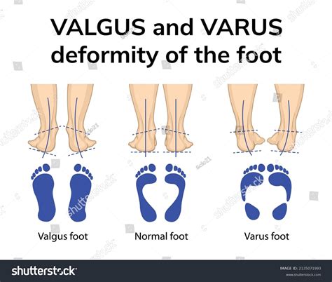 461 Varus Feet Images, Stock Photos, 3D objects, & Vectors | Shutterstock