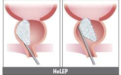 Holmium Laser Prostatectomy (HOLEP) | NU Hospitals