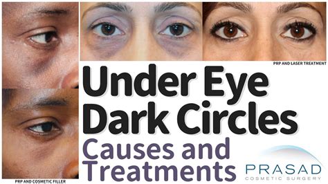 What Causes Dark Under Eyes - Infoupdate.org