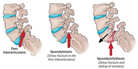 Spondylolysis causes, symptoms, diagnosis, treatment & prognosis