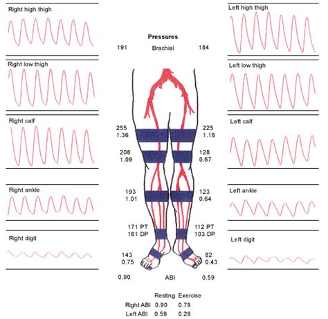 Intermittent Claudication